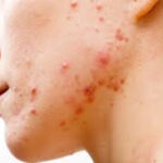 जाने मुंहासे (Pimples) के कारण, आयुर्वेदिक चिकित्सा Practical tips के साथ Pimples