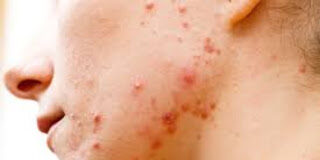 जाने मुंहासे (Pimples) के कारण, आयुर्वेदिक चिकित्सा Practical tips के साथ Pimples