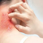 फंगल इन्फेक्शन का कारण एवं आयुर्वेदिक उपचार (FUNGAL INFECTION) Ringworm