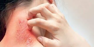 फंगल इन्फेक्शन का कारण एवं आयुर्वेदिक उपचार (FUNGAL INFECTION) Ringworm