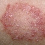 10 Reasons for Fungal Infections and Ayurvedic Treatment: A Holistic Approach to Healing