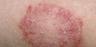 10 Reasons for Fungal Infections and Ayurvedic Treatment: A Holistic Approach to Healing