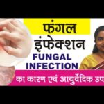 फंगल संक्रमण के 10 कारण और आयुर्वेदिक उपचार