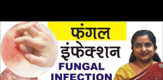 फंगल संक्रमण के 10 कारण और आयुर्वेदिक उपचार